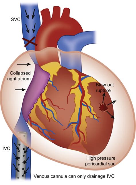 left ventricular rupture rv